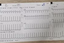 Tưởng mệt thông thường, không ngờ 2 tuổi nguy kịch vì nhịp nhanh trên thất