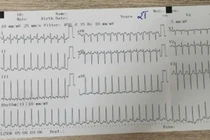 Tưởng mệt thông thường, không ngờ 2 tuổi nguy kịch vì nhịp nhanh trên thất