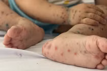 Hà Nội giảm số ca sốt xuất huyết, tăng ca tay chân miệng trong tuần