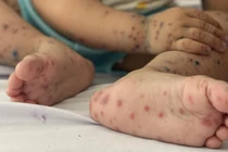 Hà Nội giảm số ca sốt xuất huyết, tăng ca tay chân miệng trong tuần