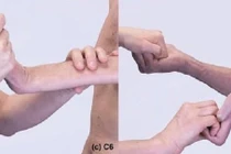 Tay mất vận động do liệt đám rối thần kinh