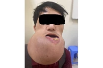 U xương khổng lồ ở chàng trai 24 tuổi không có tiền chữa trị