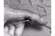 Đinh dài 5cm xuyên thấu ngón tay người phụ nữ 42 tuổi
