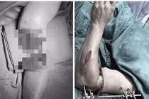 Nối thành công cánh tay bị đứt lìa cho bệnh nhân ở Nghệ An