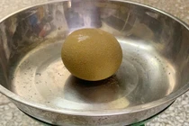 Lấy sỏi bàng quang to như quả cam ra khỏi cơ thể