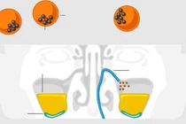 Ứng dụng vi robot trong xử lý viêm xoang bằng công nghệ cao