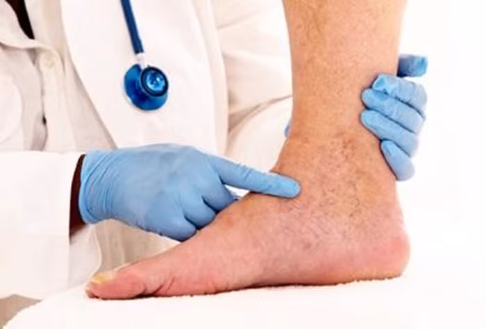 Che do dinh duong cho nguoi benh huyet khoi tinh mach sau