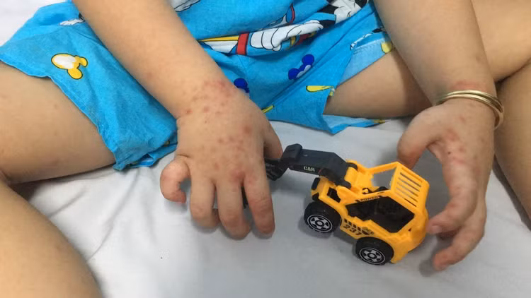 Ha Noi co 313 ca mac tay chan mieng trong tuan qua