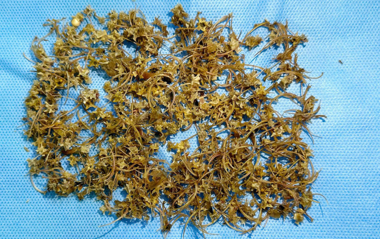 Nguoi dan ong bi tac ruot do nuot hang ngan manh xuong ran