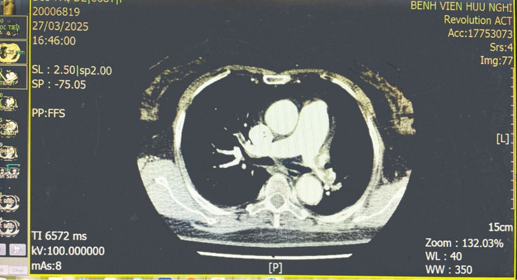 Cuu song benh nhan tac dong mach phoi bang ky thuat tieu soi huyet