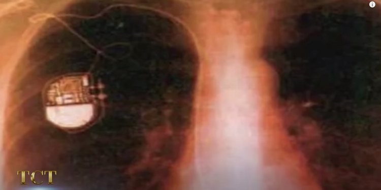 Xac uop 2.500 tuoi co nhip tim, nghi nguoi ngoai hanh tinh 