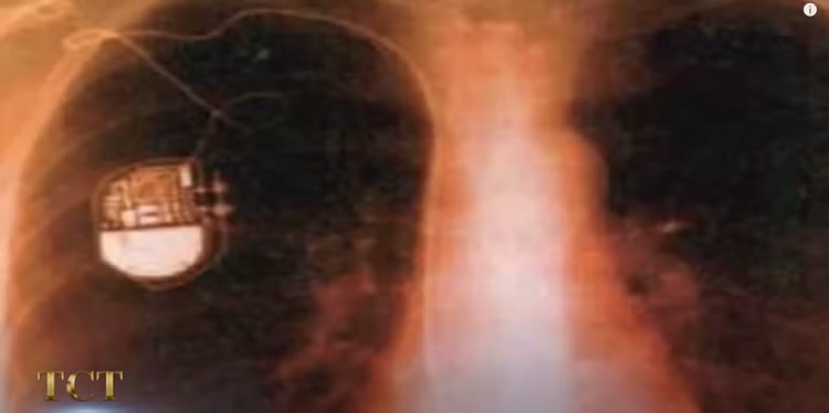 Xac uop 2.500 tuoi co nhip tim, nghi nguoi ngoai hanh tinh 