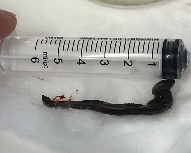 Phát hiện con vắt dài hơn 6 cm sống trong mũi bệnh nhân Phat hien con vat dai hon 6 cm song trong mui benh nhan