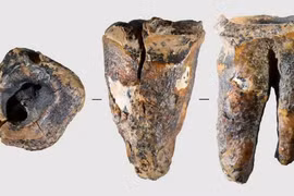 Răng người Neanderthal 60.000 năm tuổi hé lộ bí mật y học cổ đại