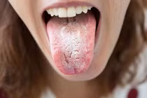 Đừng chủ quan với mảng trắng bất thường ở miệng