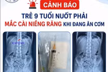 Trẻ 9 tuổi nuốt phải mắc cài niềng răng khi ăn cơm