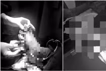 Bệnh nhân ở Quảng Trị hồi phục sau ca nối bàn chân đứt rời