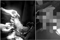 Bệnh nhân ở Quảng Trị hồi phục sau ca nối bàn chân đứt rời