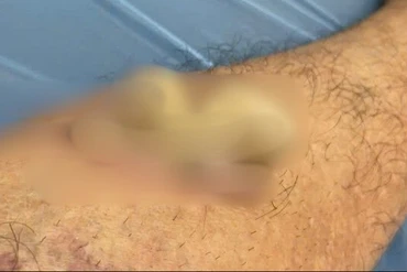 Điều trị u nhú tế bào gai sừng hóa bằng laser tại Đồng Nai