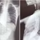 Trẻ sợ ăn kéo dài không ngờ do co thắt tâm vị nguyên phát
