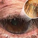 Phát hiện ổ rận mu ký sinh ở mí mắt người phụ nữ
