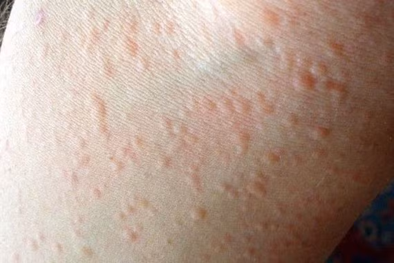 WHO cảnh báo: Nửa dân số thế giới có thể mắc dị ứng vào 2050