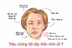 Liệt dây thần kinh số 7: Nhận biết sớm để tránh biến chứng nặng
