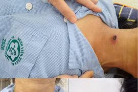 Sốt cao kéo dài, đừng bỏ qua tổn thương nhỏ trên da
