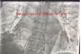 Nhịp tim chỉ 27–35 lần/phút, cụ ông 77 tuổi nguy kịch