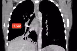 Bé 6 tuổi viêm phổi tái phát, nguyên nhân bất ngờ là mảnh răng sâu