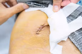 Xơ vữa động mạch chủ, người đàn ông đau bụng mất ăn, mất ngủ