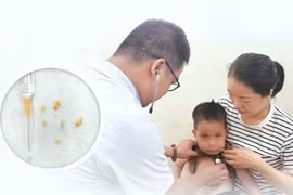 Bé trai 2 tuổi nguy kịch vì 7 mảnh hạt lạc lọt vào đường thở