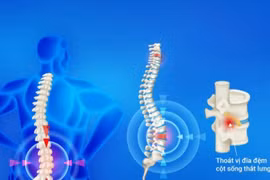 Đau lưng, tê chân kéo dài: Đừng chủ quan, đừng cố tập khi đau tăng