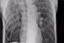 COPD khó thở bất thường, cụ ông 71 tuổi suy hô hấp vì tràn khí màng phổi
