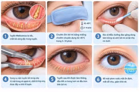 Mắt ngứa, cộm, dính vảy mỗi sáng: Đừng xem nhẹ viêm bờ mi