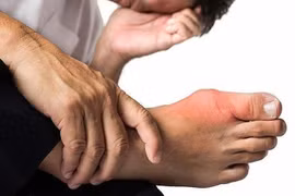 Acid uric cao: Đừng mắc sai lầm dễ kích hoạt cơn gút cấp