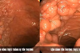 Chữa trị tổn thương tiền ung thư trực tràng bằng nội soi ESD