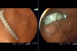 Cứu bé 11 tháng tuổi nguy kịch vì nuốt cả đinh vít 4 cm và nhiều dị vật