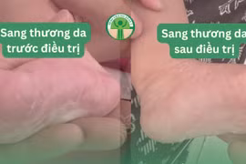 Mẹ mắc giang mai khi mang thai, con nhiễm bệnh dễ viêm não