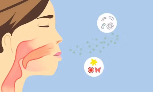 Nguyên nhân viêm nắp thanh quản chủ yếu do vi khuẩn như Haemophilusenzae loại B, liên cầu tan máu, tụ cầu và phế cầu khuẩn,... gây nên. Ảnh: SH
