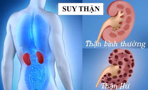 Giật mình 9 nhóm người dễ suy thận, số 5 bất ngờ nhất - Hình 3