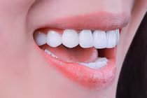 Tác hại của việc lạm dụng tẩy trắng răng tại nhà