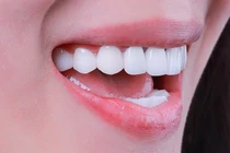 Tác hại của việc lạm dụng tẩy trắng răng tại nhà