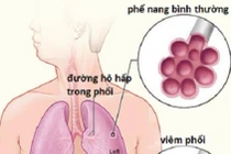Cẩn thận viêm phổi nặng do vi khuẩn kháng thuốc