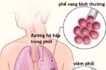 Cẩn thận viêm phổi nặng do vi khuẩn kháng thuốc