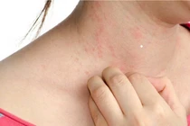 Bí quyết phòng tránh dị ứng khi thời tiết thay đổi