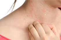 Bí quyết phòng tránh dị ứng khi thời tiết thay đổi