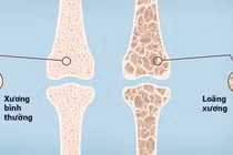 Nguy cơ loãng xương ở phụ nữ sau mãn kinh