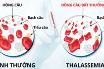 Tan máu bẩm sinh, căn bệnh di truyền nguy hiểm