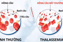 Tan máu bẩm sinh, căn bệnh di truyền nguy hiểm